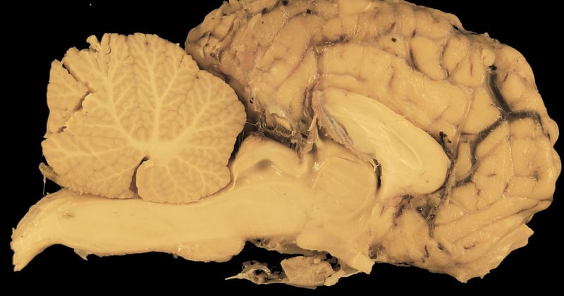 L'essor des implants de mémoire : vers une humanité augmentée